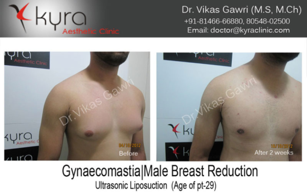 Advanced Chest Liposuction Surgery In Ludhiana, Punjab, India